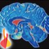 BrainDamageNet